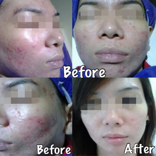 eska group batam eska aesthetic clinic & medispa  1-skin-resurfacing-refining-pores