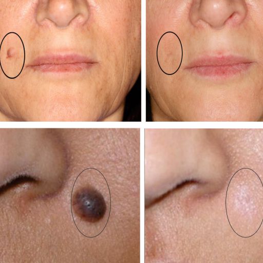 eska group batam eska aesthetic clinic & medispa  2-laser-nevus-removal