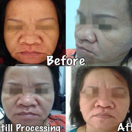 eska group batam eska aesthetic clinic & medispa  3-skin-resurfacing-tightening