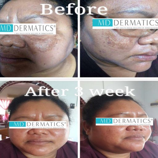 eska group batam eska aesthetic clinic & medispa  5-skin-resurfacing-pigmentation