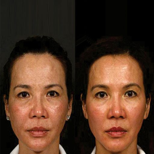 eska group batam eska aesthetic clinic & medispa  Full Face (Eye area, Cheeks & Chin)