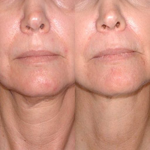 eska group batam eska aesthetic clinic & medispa  Full Neck (Jaw & Neck)