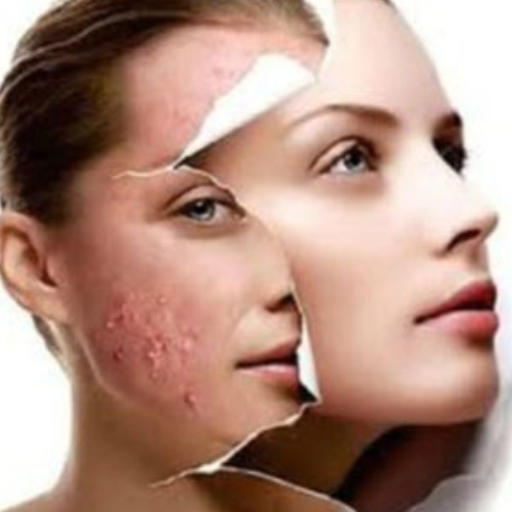 eska group batam eska aesthetic clinic & medispa  advance-machine-with-ptf-bye2-acne
