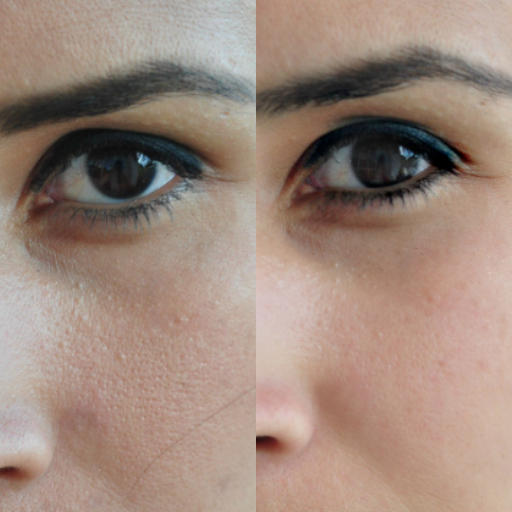 eska group batam eska aesthetic clinic & medispa  advance-machine-with-ptf-refining-pores